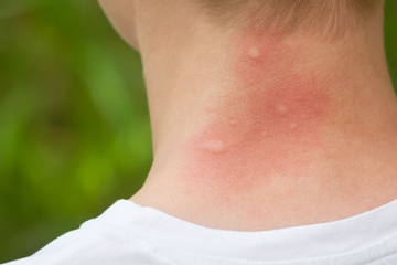 Khi nào cần tới bác sĩ khi bị côn trùng cắn – vấn đề phổ biến vào mùa hè?