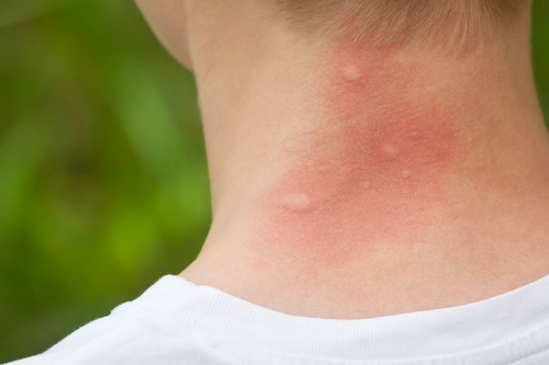 Khi nào cần tới bác sĩ khi bị côn trùng cắn – vấn đề phổ biến vào mùa hè?