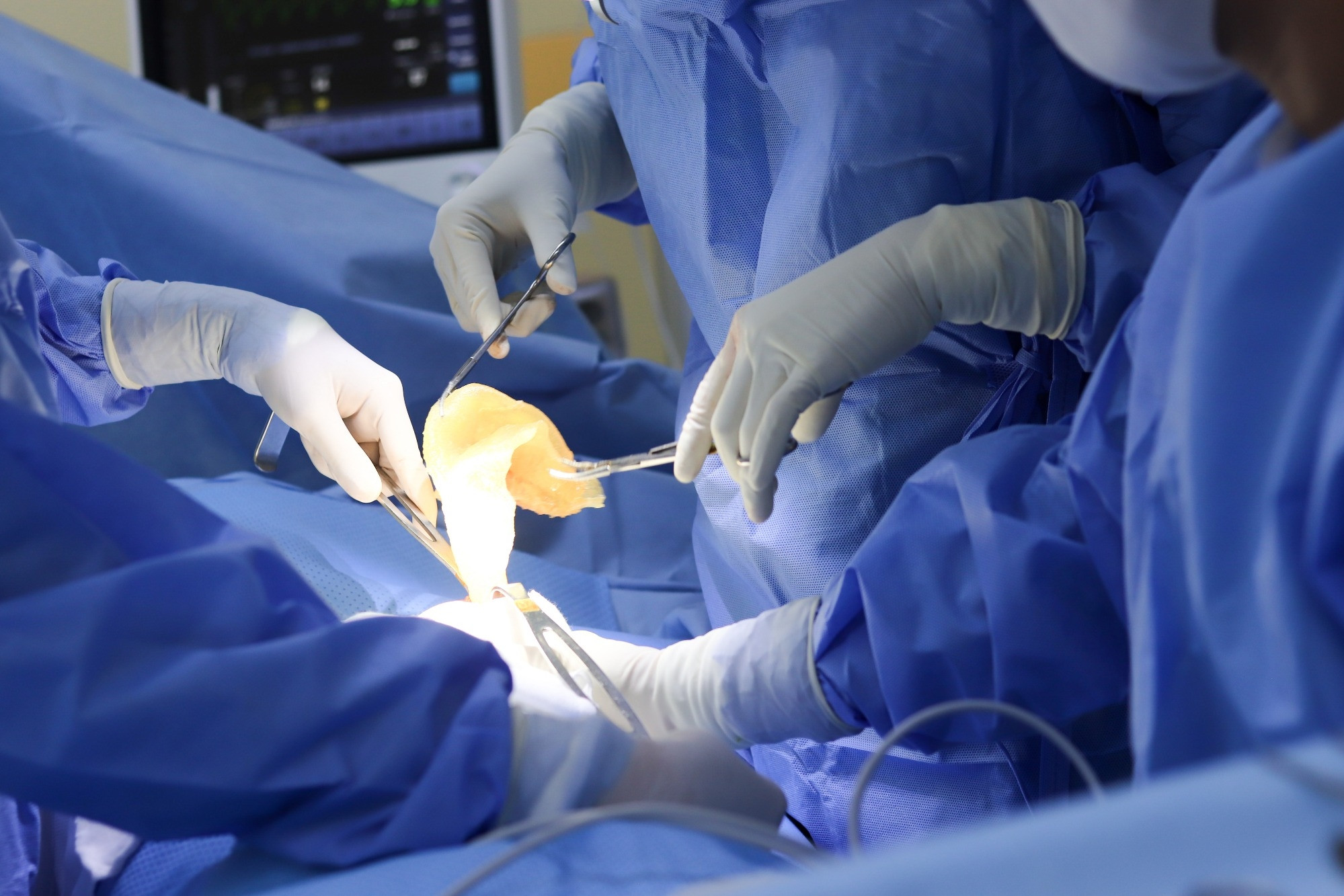 Tháo túi ngực với dao siêu âm Harmonic, bệnh nhân chóng hồi phục