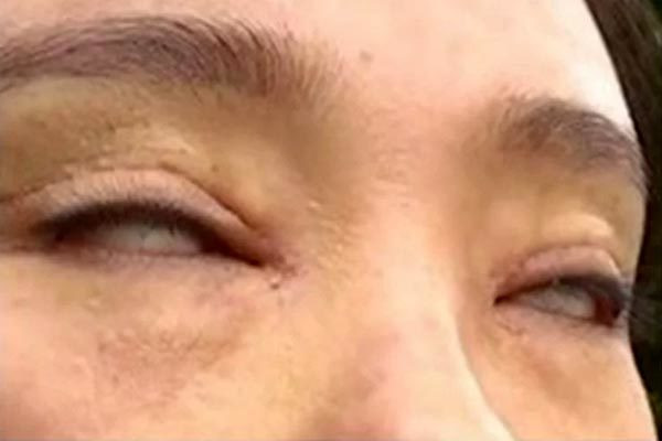 Phát hoảng vì không thể nhắm kín mắt sau thẩm mỹ hai mí