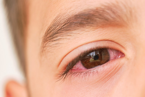 Dịch đau mắt đỏ: Những triệu chứng cần đặc biệt lưu ý và cách phòng ngừa lây lan