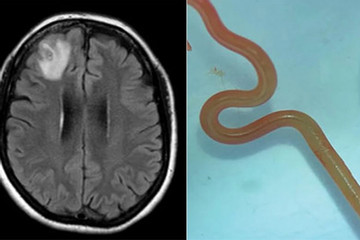 Lần đầu tiên trên thế giới: Phẫu thuật gắp giun còn sống ra khỏi não người