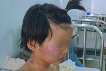 Bốn trẻ nhỏ bị kẹt trong đám cháy ở Tây Ninh: Một bé bỏng 40% cơ thể