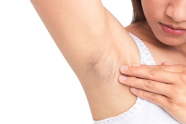 Thói quen khiến da nách thâm đen