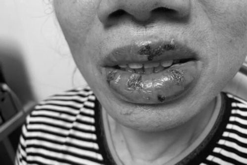 Người phụ nữ U70 'cầu cứu' bác sĩ sau 5 ngày xăm môi