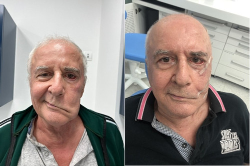 Phẫu thuật khôi phục nét mặt cho bệnh nhân bị liệt dây thần kinh số 7