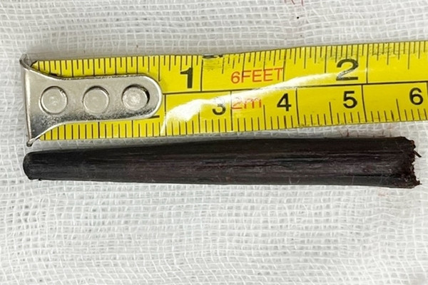 Thanh niên ở Bình Dương không hay biết có đũa gỗ dài 6cm trong mắt