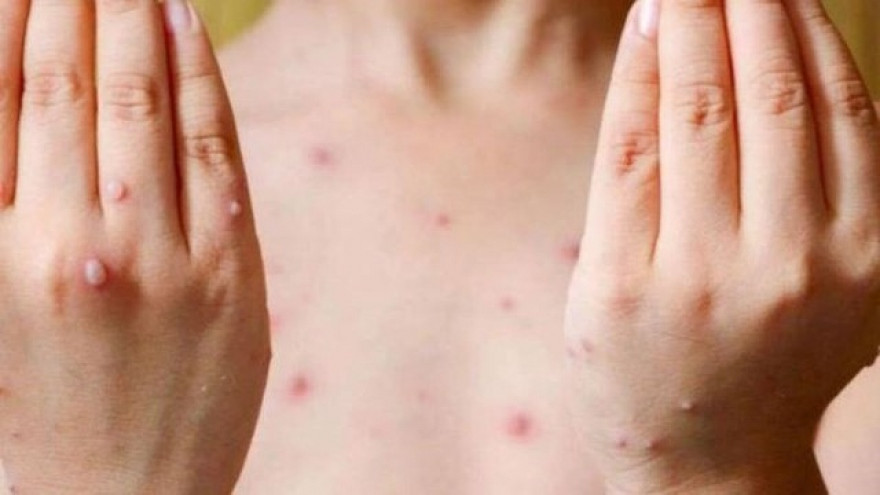 monkeypox 2.jpg