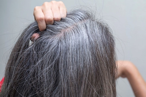 Thực hư căn bệnh khiến tóc đột nhiên bạc trắng