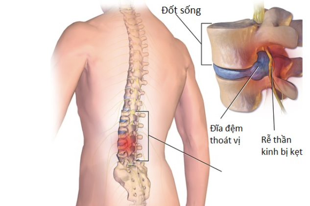 Bệnh viện đầu tiên có kỹ thuật mới giúp người mắc bệnh cột sống nhanh khỏi