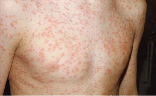 42 measles cases reported in Vietnam since early this year