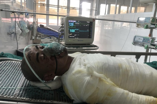 Người đàn ông tâm thần tự thiêu mình chìm trong nguy kịch