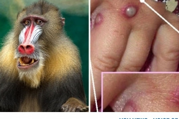 Three monkeypox cases recorded in Mekong Delta province