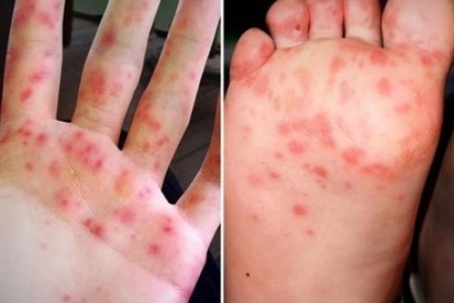 Vietnam reports increase in hand, foot, and mouth cases