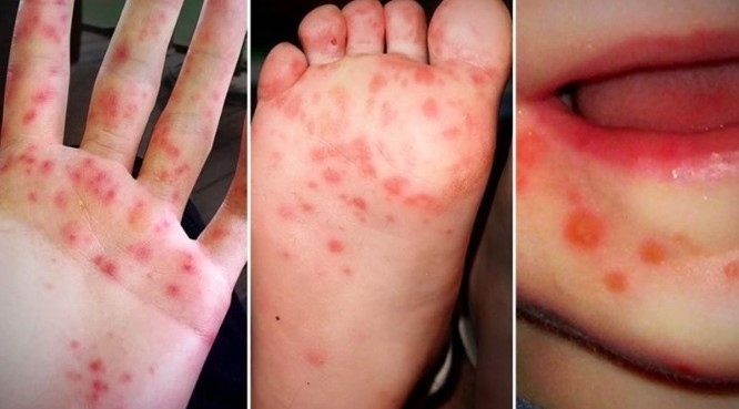 vietnam reports increase in hand, foot, and mouth cases picture 1