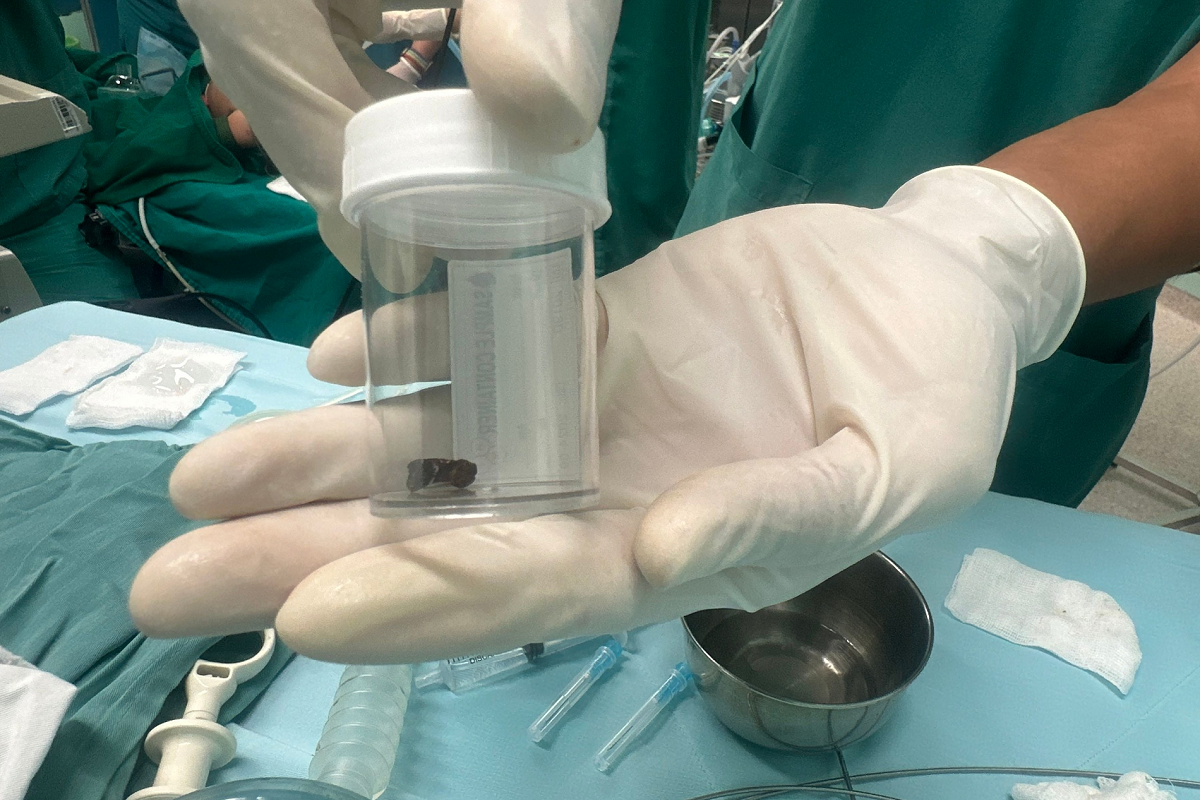 Bé trai 8 tháng tuổi nuốt cuống xoài, 2 bệnh viện phối hợp gắp ra