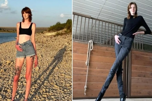 Cuộc sống của cô gái 21 tuổi có đôi chân dài nhất thế giới