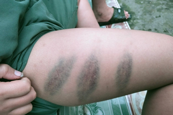 Bà mẹ ở Phú Thọ tố chồng cũ bạo hành con thâm tím, đen sì 2 chân