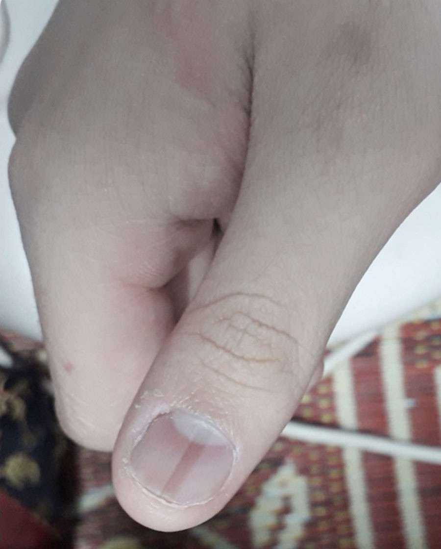 Dù đang trong tình trạng khó khăn vì dịch bệnh Covid-19, những dấu hiệu lạ trên móng tay lại đang trở thành thông điệp cách mạng mang tính cộng đồng. Hãy chăm sóc móng tay của bạn và nếu phát hiện dấu hiệu lạ, hãy liên lạc ngay với các cơ quan y tế.