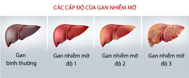 cac-cap-do-cua-benh-gan-nhiem-mo