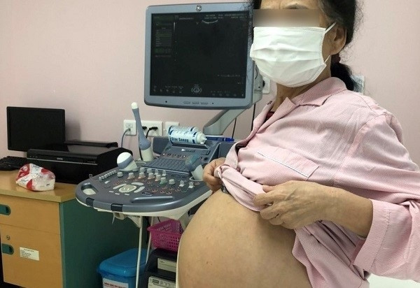 Cụ bà 71 tuổi mang khối u vùng bụng tương đương thai nhi 9 tháng