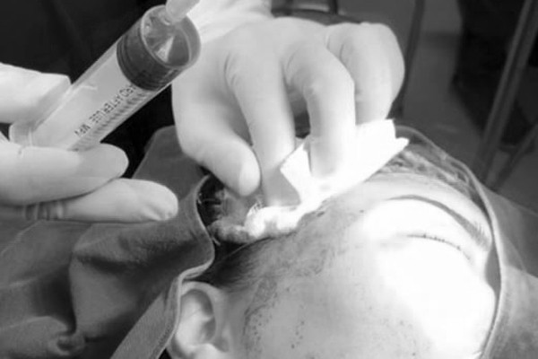 Gần chục ca tai biến tiêm filler trong nửa tháng