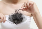 F0 khỏi bệnh rụng tóc đến hói đầu, bác sĩ chỉ cách khắc phục