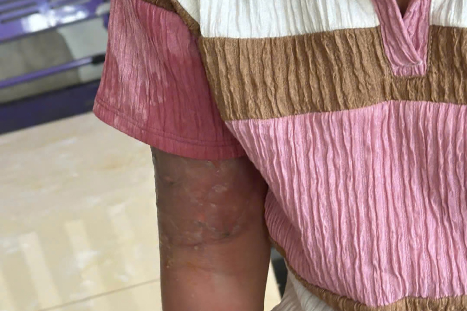 Bé gái 12 tuổi làm mất vé số bị 'mẹ nuôi' nhẫn tâm tạt nước sôi gây bỏng nặng