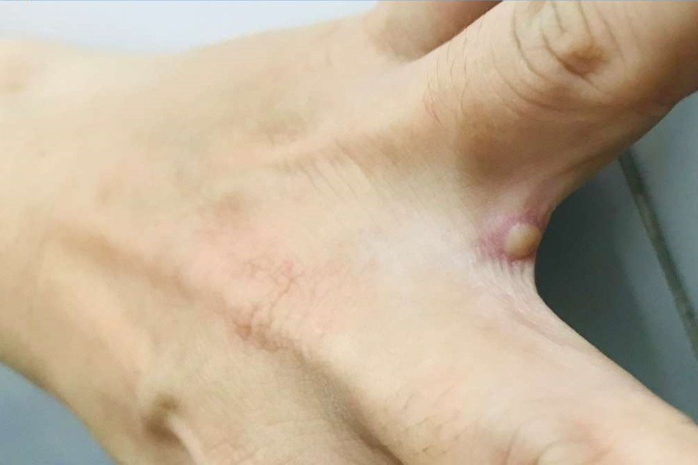 Bệnh đậu mùa khỉ đột biến với tốc độ chưa từng có