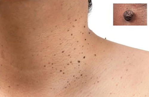 Người phụ nữ mắc 3 bệnh ung thư, bác sĩ cảnh báo dấu hiệu dễ ...