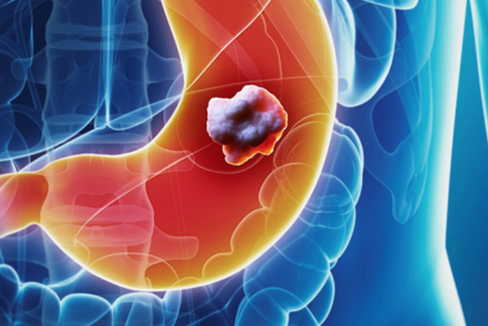 ung thu da day 1.png