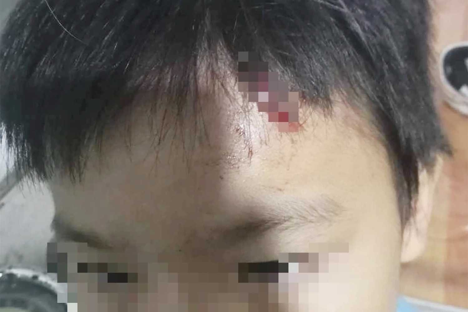 Vừa chịu án tù treo tội bạo hành, mẹ kế lại bị nghi tiếp tục đánh con rách trán
