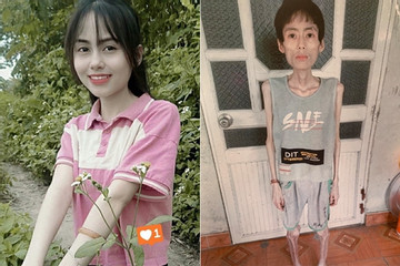 Cô gái Hưng Yên nặng 18kg sau nhiều năm không ăn cơm để giảm cân
