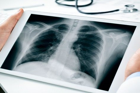 Bộ Y tế đề xuất BHYT trả 100% chi phí khám chữa bệnh ung thư, đột quỵ
