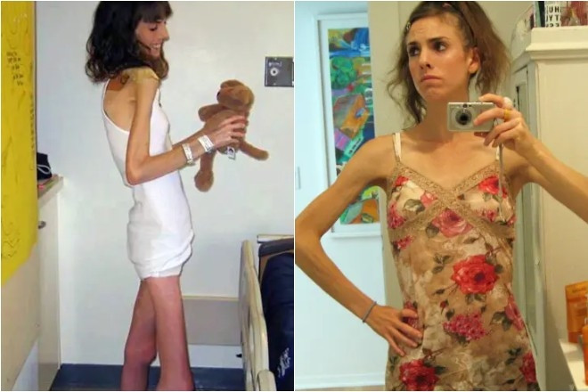 Hành trình lột xác ngoạn mục của cô gái 'gầy trơ xương' 20 tuổi chỉ nặng 25kg