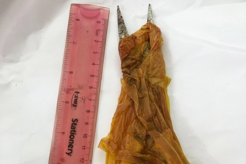 Bị tai nạn bất ngờ, bé gái đi cấp cứu với cây kéo 'dính' trên đỉnh đầu