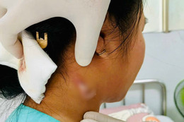 21 ngày chạy đua cứu bệnh nhân nhiễm vi khuẩn Whitmore, tỷ lệ tử vong tới 40% Bé gái 14 tuổi ở Đồng Nai nhiễm ‘vi khuẩn ăn thịt người’