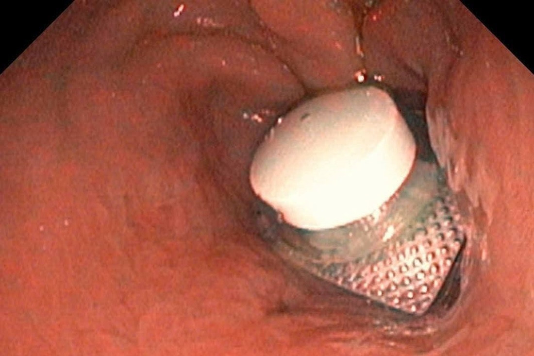 Cấp cứu người đàn ông đau bụng dữ dội, bác sĩ phát hiện 'vật thể' ít ai ngờ tới