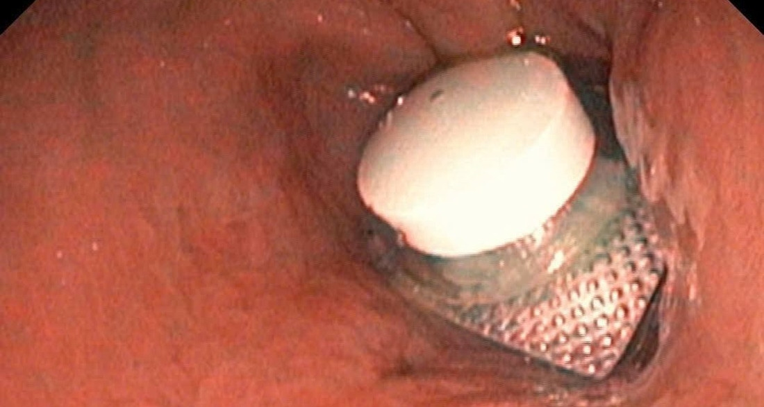 Cấp cứu người đàn ông đau bụng dữ dội, bác sĩ phát hiện "vật thể" ít ai ngờ tới