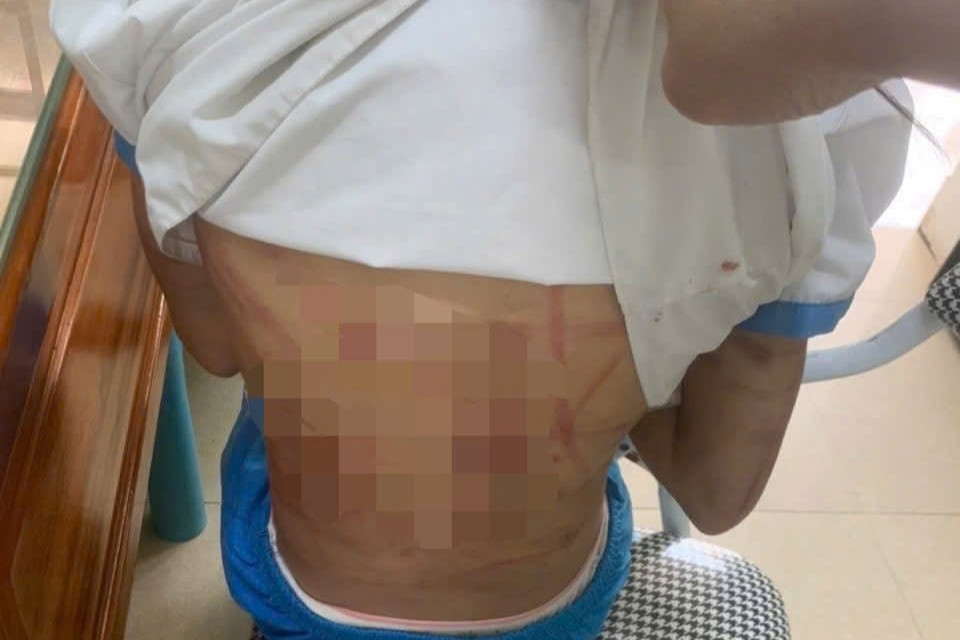 Bé gái lớp 5 ở Hà Tĩnh nghi bị bạo hành, cơ thể chằng chịt vết thương