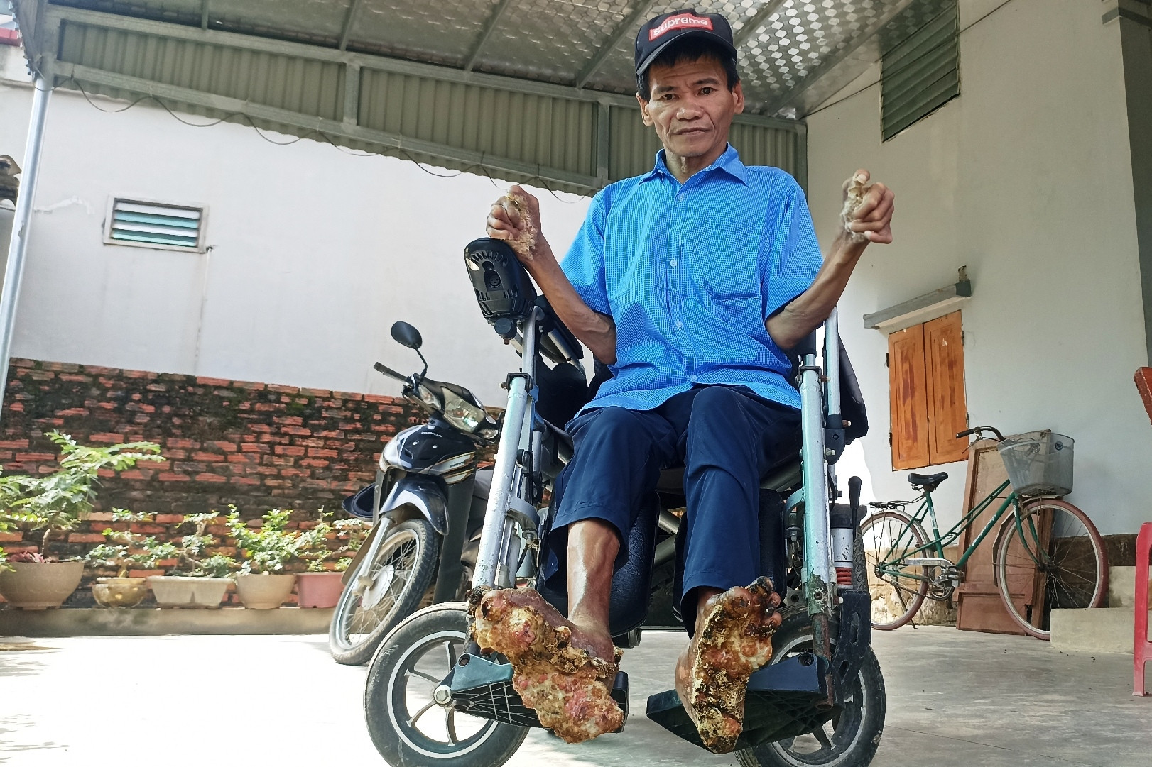 Cuộc sống của người đàn ông mắc bệnh 'người cây' hiếm gặp ở Ninh Bình
