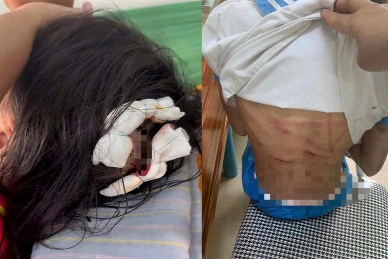 Nữ hiệu trưởng rụng rời khi bé gái lớp 5 thương tích khắp người, nghi bị bố dượng đánh