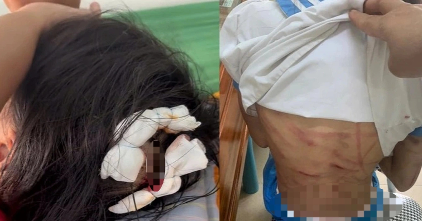 Bắt khẩn cấp cha dượng vụ bé gái lớp 5 bị đánh đập dã man