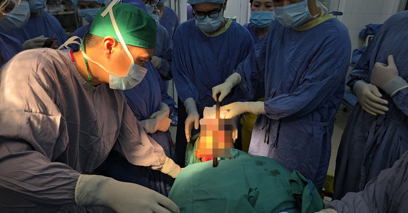 Cấp cứu thành công nam sinh bị thanh sắt 3 mét xuyên từ mặt qua gáy