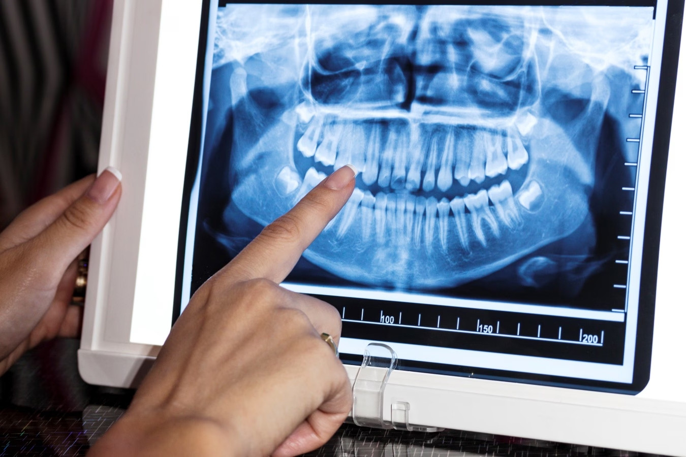 Bé 11 tuổi có 81 chiếc răng, bác sĩ lý giải nguyên nhân chuyện 'xưa nay hiếm'