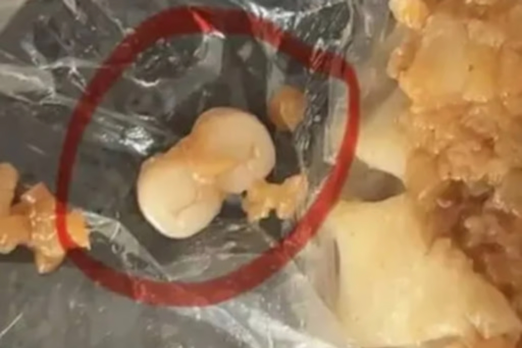 Liên tiếp phát hiện răng người trong đồ ăn tại Trung Quốc