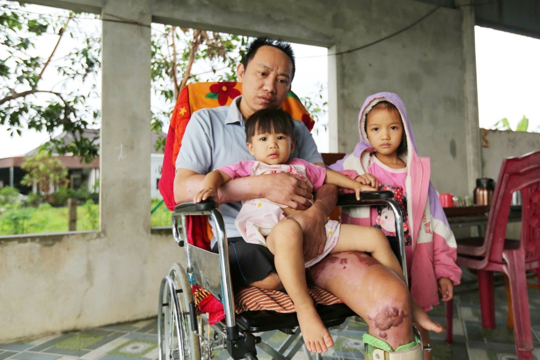 Người đàn ông trụ cột bị điện giật cụt chân, gia đình lâm cảnh khánh kiệt