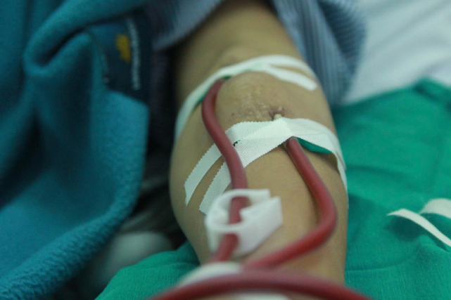 Suy thận ở tuổi 29, người phụ nữ tiếc nuối vì bỏ qua 1 dấu hiệu cảnh báo ở chân