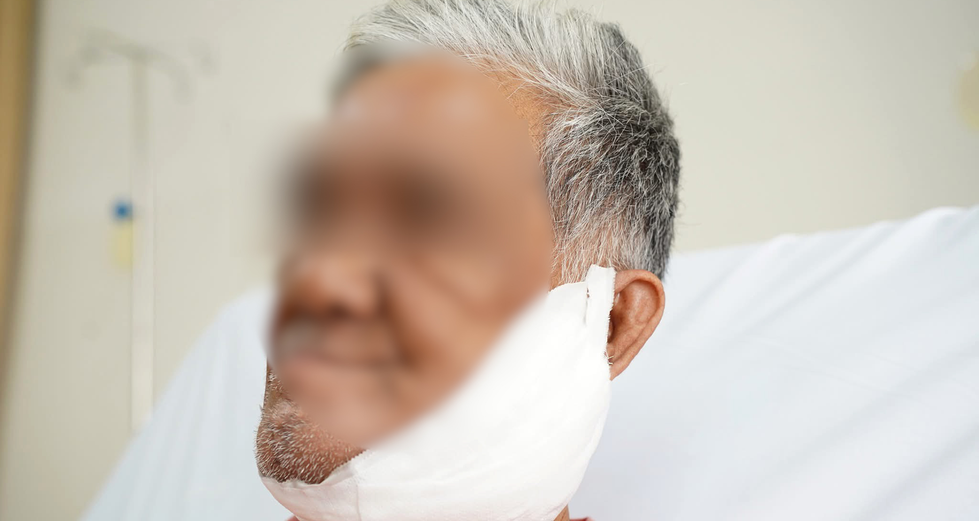 Người đàn ông 6 năm không dám soi gương vì nẹp vít lòi ra khỏi mặt