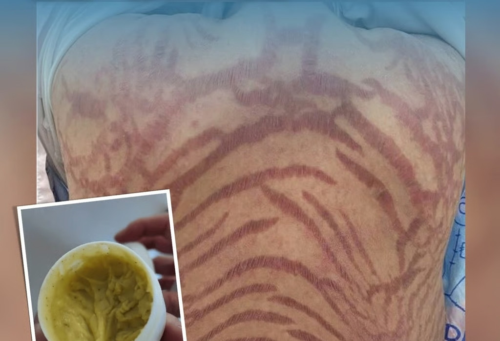 Người phụ nữ da vằn vện như hổ do bôi thuốc mỡ